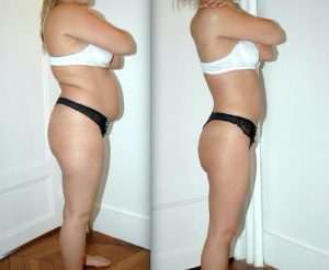 resultat lipoaspiration tunisie