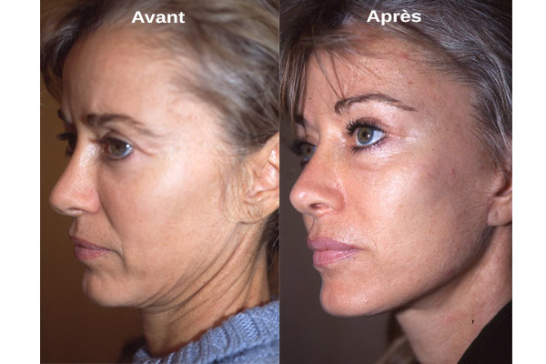 lifting visage en tunisie chirurgie esthetique clinique medespoir