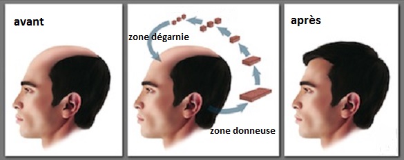 greffe de cheveux en Tunisie