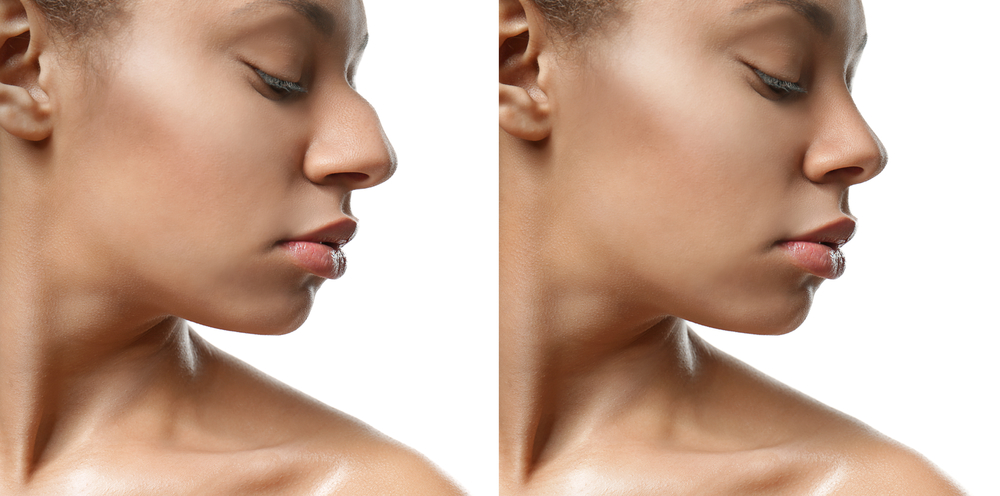 rhinoplastie avant apres