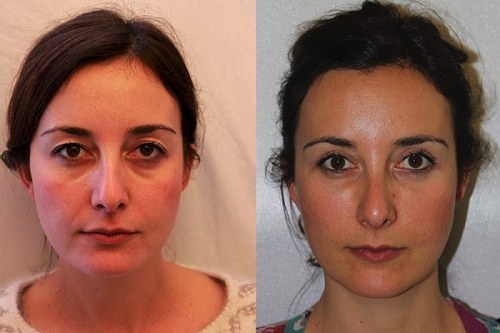 lipofilling du visage tunisie